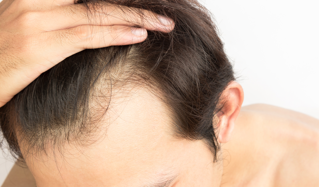 Man examining hair loss after taking creatine