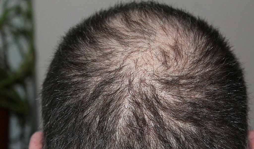 Is This FINALLY The Cure For Baldness? | Male Health Review