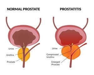 Enlarged Prostate Symptoms, Causes, and Treatment