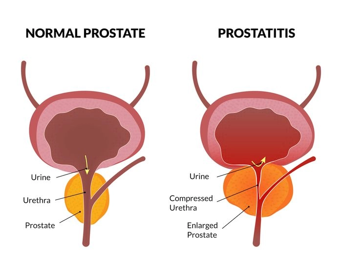 Chart depicting a normal prostate and an enlarged prostate.